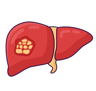 کبد چرب